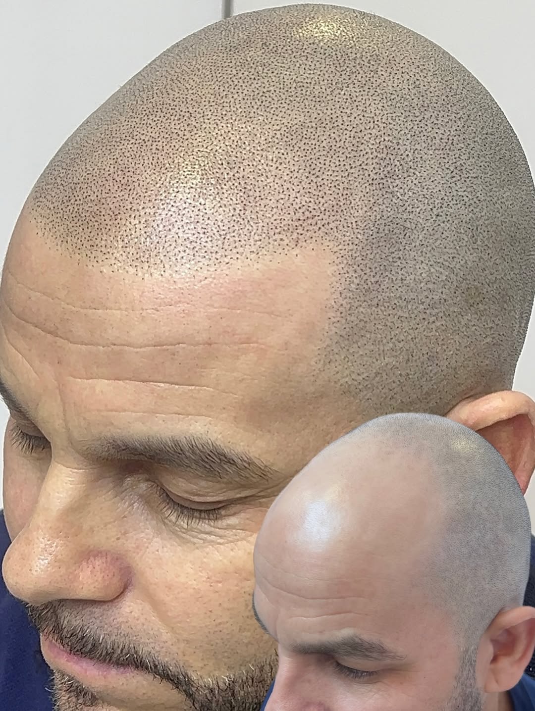 Resultado de micropigmentação capilar realista — Studio Siomara, Florianópolis