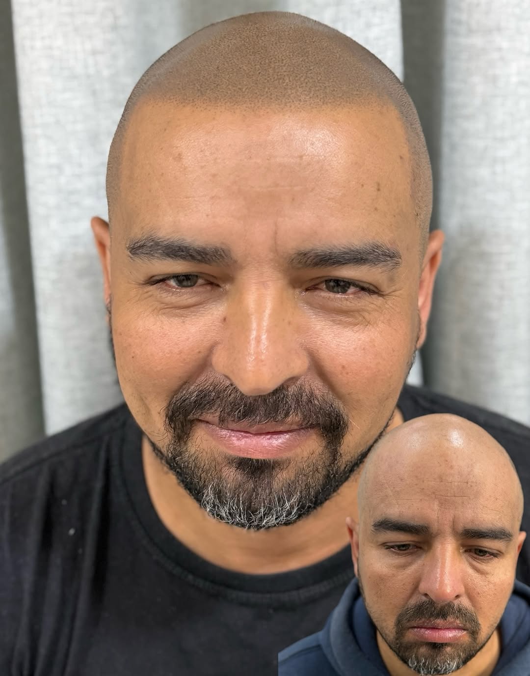 Resultado de micropigmentação capilar realista — Studio Siomara, Florianópolis